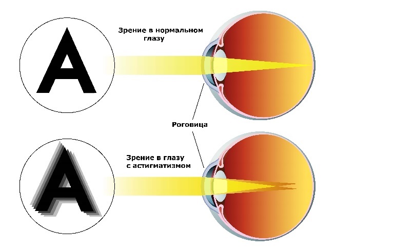 astigmatizm.jpg